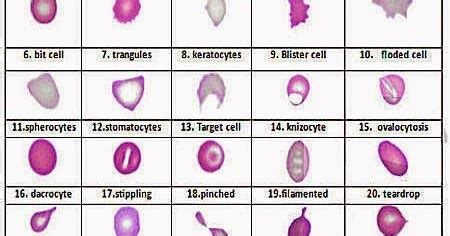poikilocytosis symptoms
